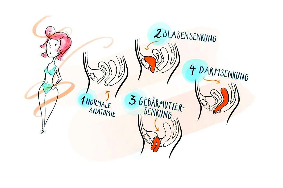 Grafik verschiedene Arten Genitalsenkung