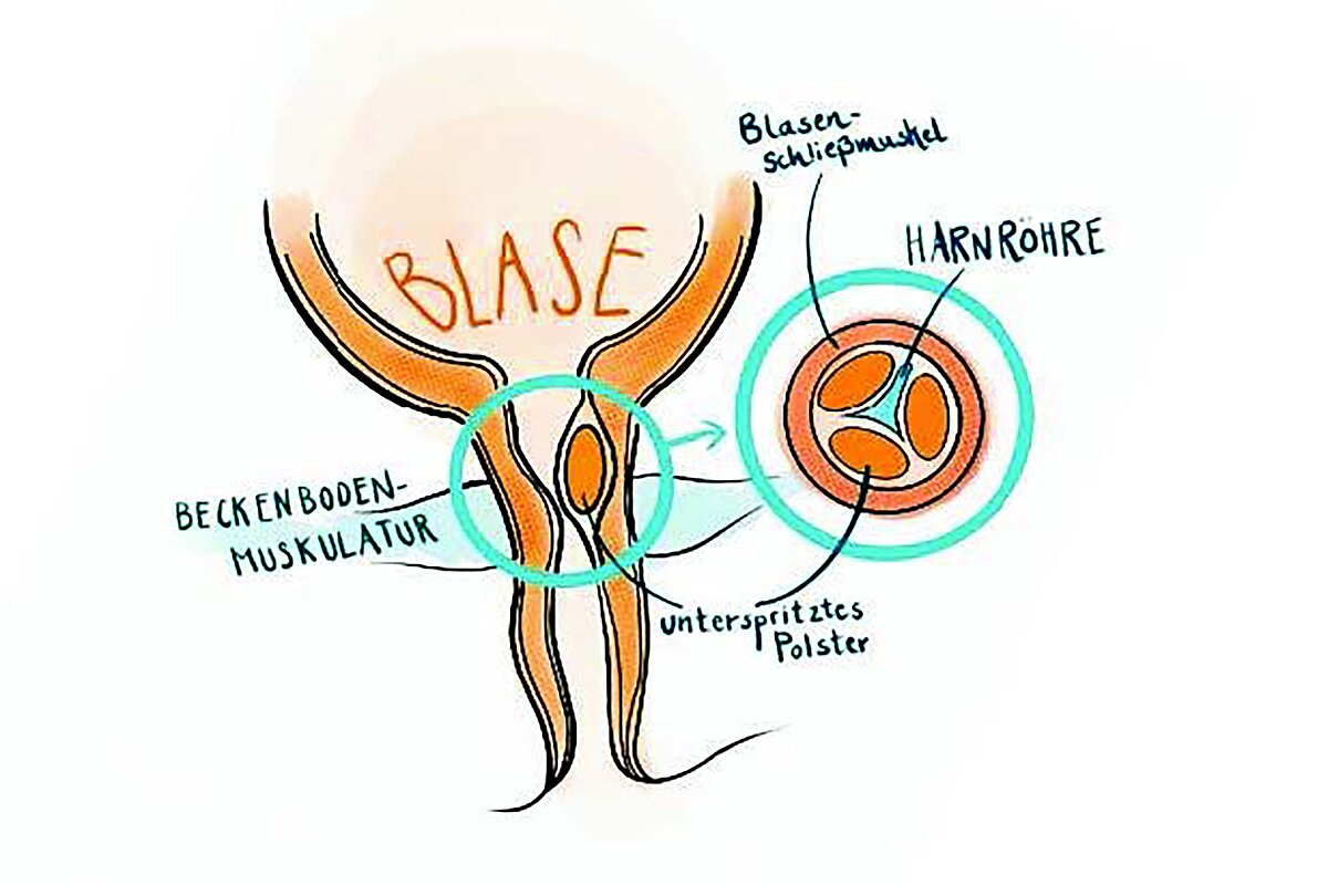 Grafik des OP-Verfahrens
