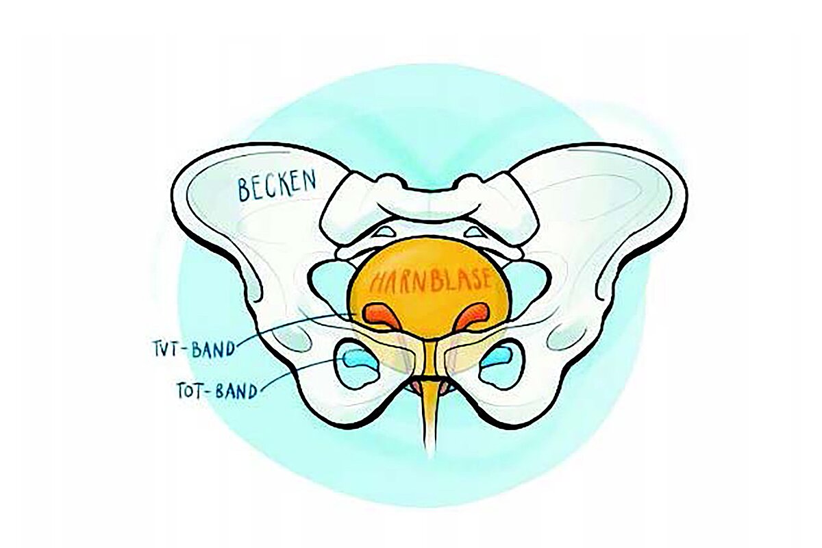 Grafik des OP-Verfahrens